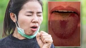 إن تقرحات اللسان والفم قد تكون أعراضاً أخرى لفيروس كورونا / 7 فبراير