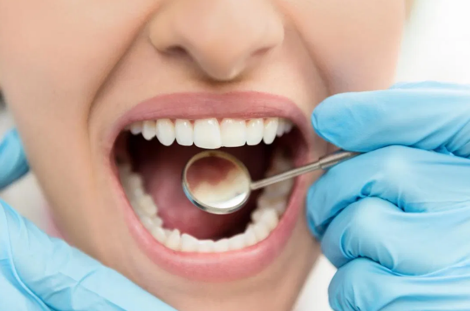 علاج تسوس الأسنان: 5 طرق شائعة