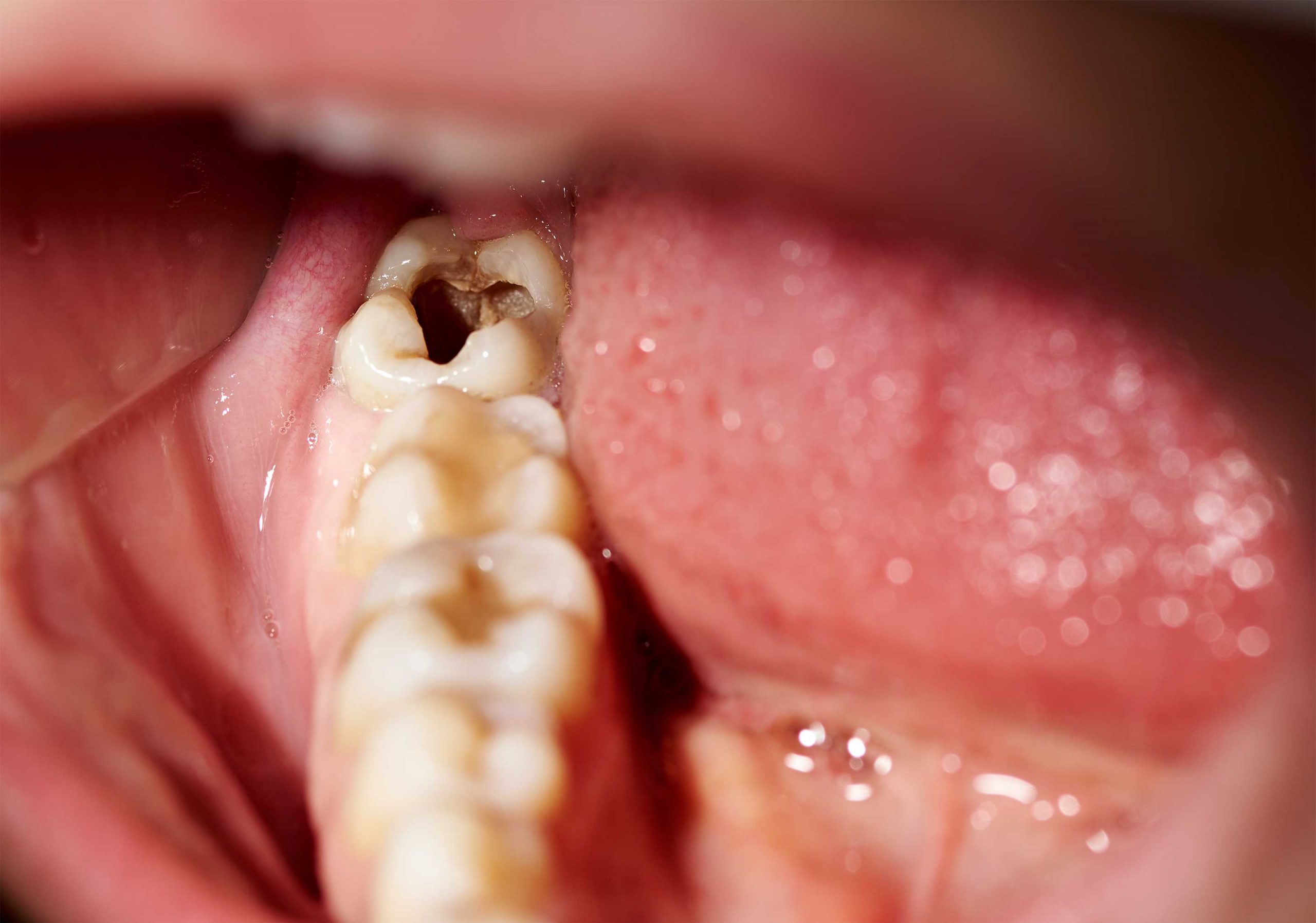 التشخيص وعلاج تسوس الأسنان