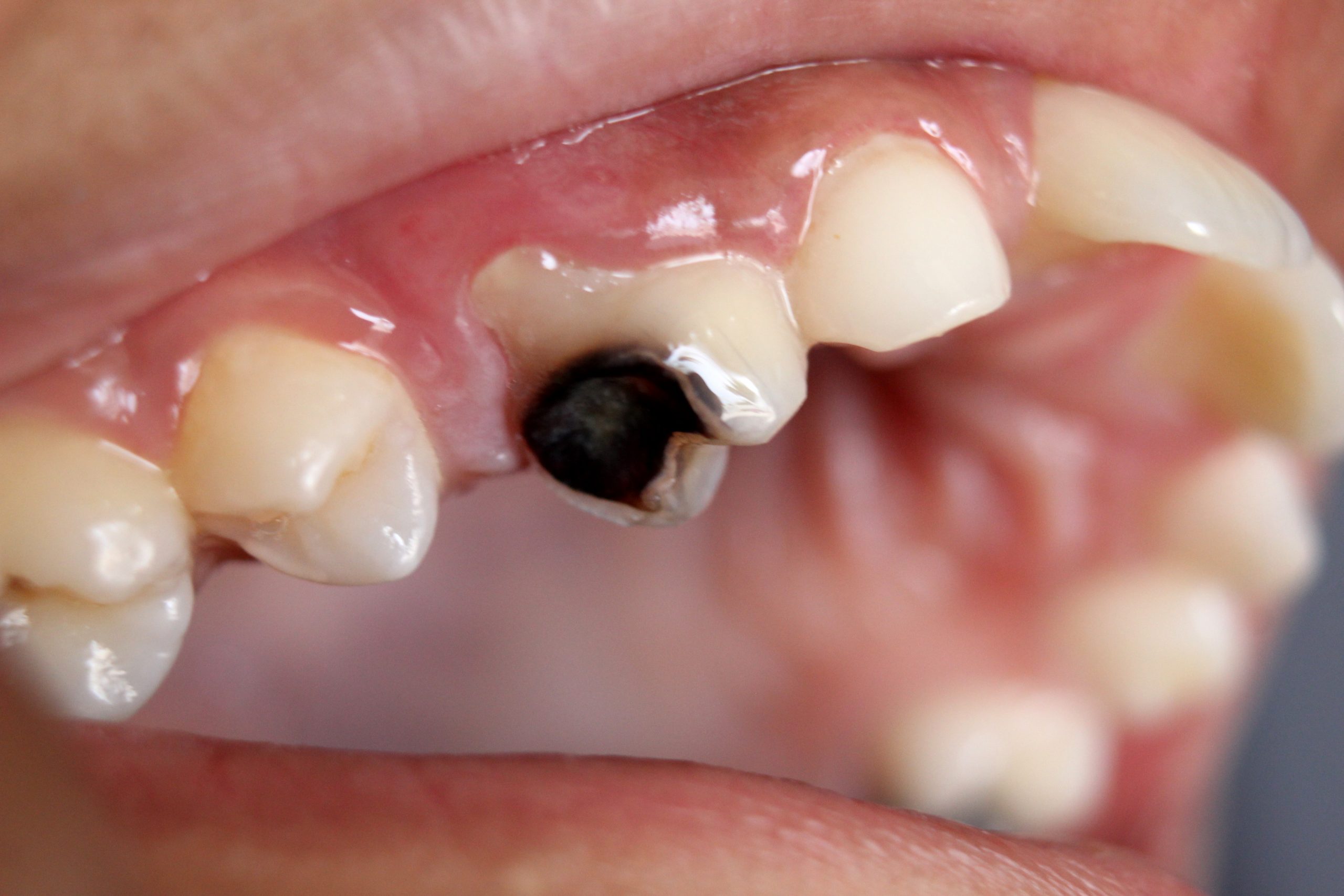 علاج تسوس الأسنان: 5 طرق شائعة